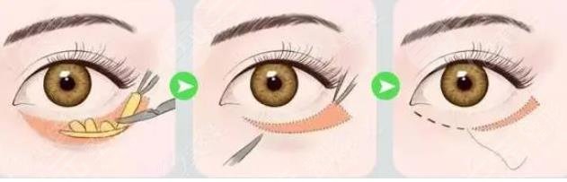 外切眼袋一般要多久才能完全恢复