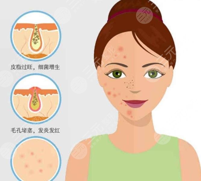 为什么会长闭合性粉刺