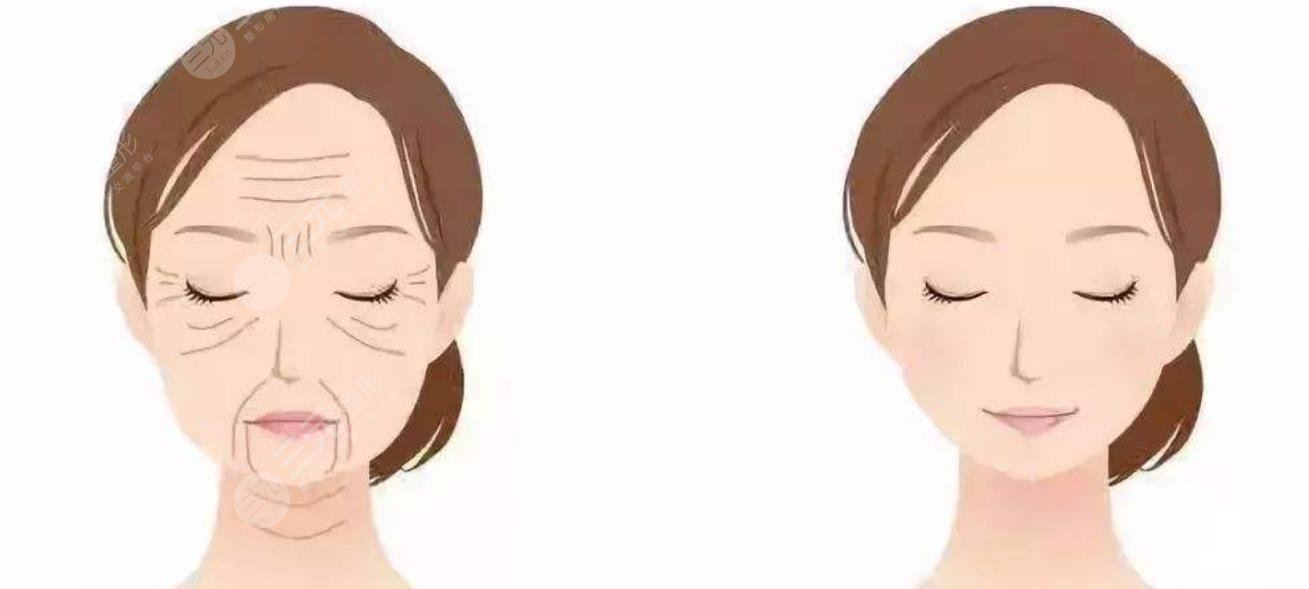 面部提升