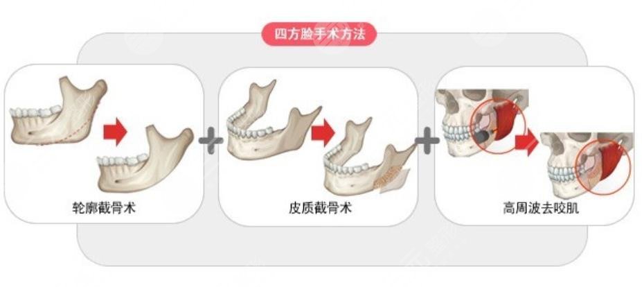 下颌角整形