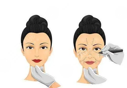 微调整形有风险吗？