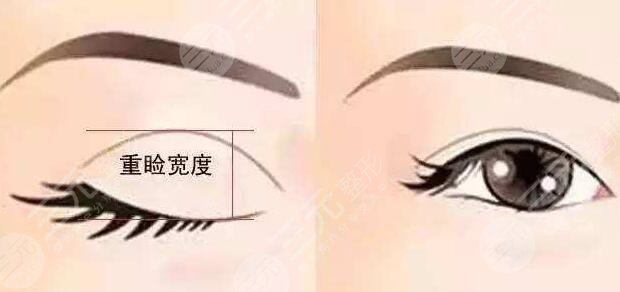 西南医院王量医生微创双眼皮案例
