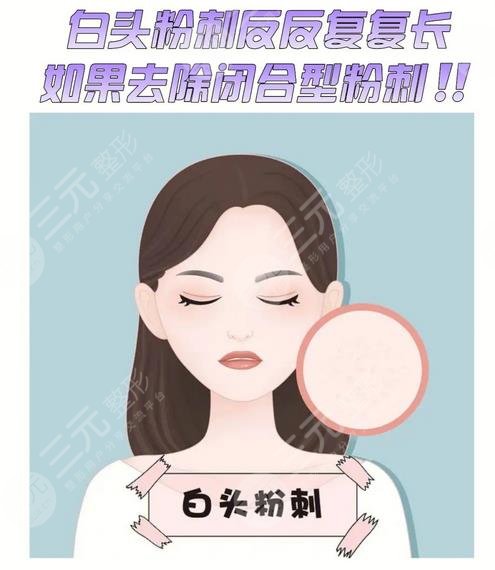 闭合性粉刺怎么清理