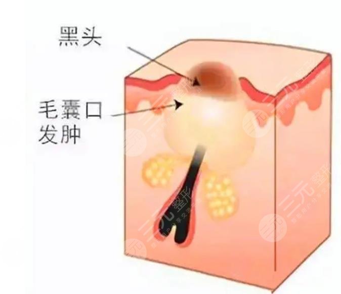 闭合性粉刺怎么清理