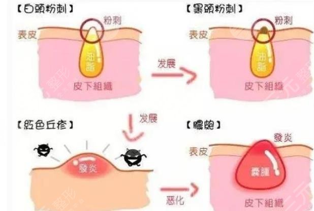 闭合性粉刺是怎么引起的