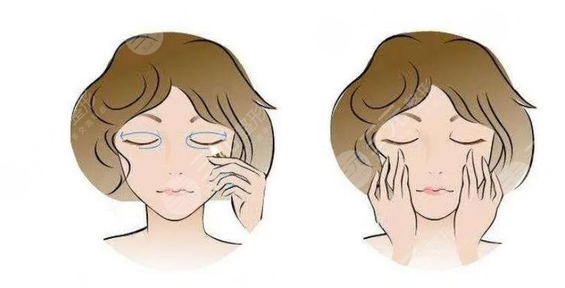 内切眼袋多久恢复正常