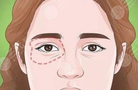 内切眼袋多久恢复正常