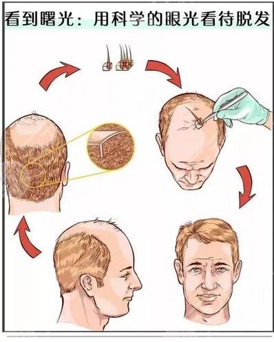 种一根头发需要多少钱