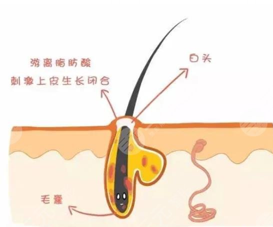 闭合性粉刺怎么调理