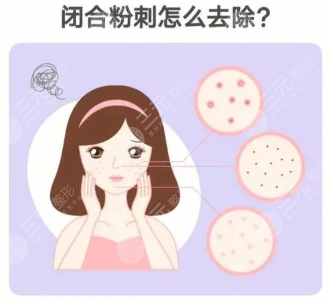 闭合性粉刺怎么调理