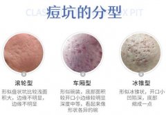 祛痘印小窍门汇总！这些方法你试过吗？