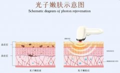 激光嫩肤有副作用吗？医美入门常识分享！优缺点讲解，值得做~