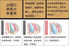 内窥镜假体丰胸安全吗，怎么样？手术常识讲解，必看！