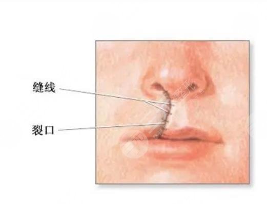 唇裂修复