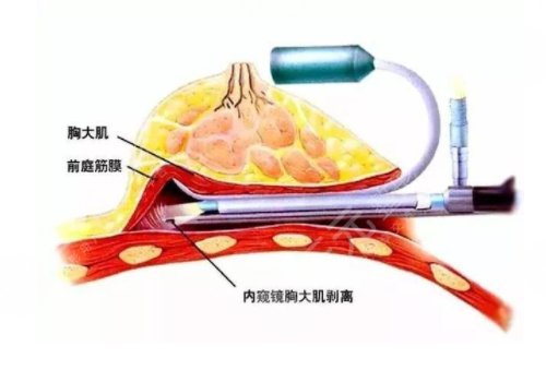 双平面内窥镜隆胸几天能不疼？