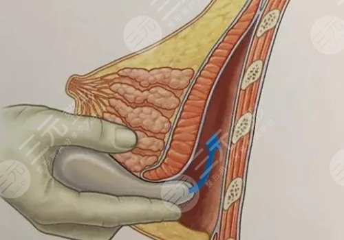 双平面内窥镜隆胸几天能不疼？