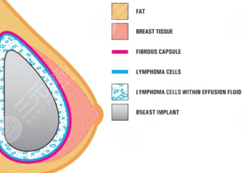 双平面内窥镜隆胸几天能不疼？