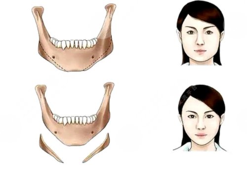 国字脸削骨手术风险大吗？