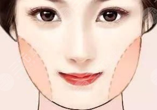 国字脸削骨手术风险大吗？