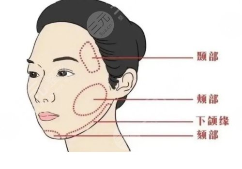 面部轮廓整形有什么后遗症？