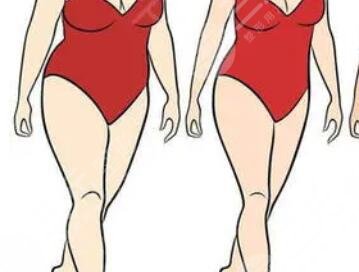 腰腹吸脂