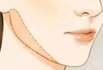 下颌缘吸脂、