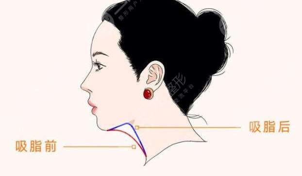 下颌缘吸脂