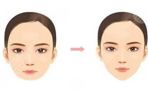 做脸部轮廓手术风险高吗？