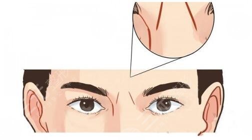 射频除皱价格是多少?