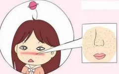 鼻翼毛孔粗大怎么办，怎么收缩？3种医美项目介绍！