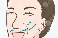 拉皮除皱的价格是多少钱？（5月平均报价10000-30000元之间）