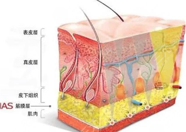 筋膜提升术
