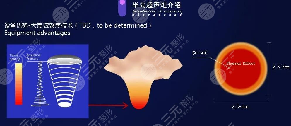 黄金超声炮和经典超声炮的区别