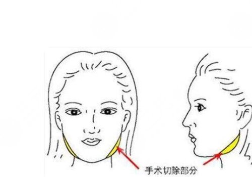 削骨三年后的真实案例图片