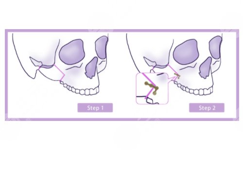 削骨三年后的真实案例图片