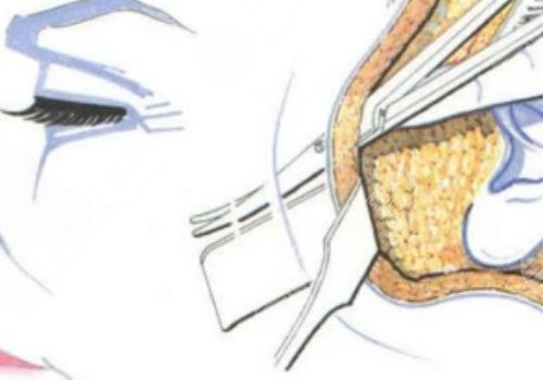 大拉皮手术15天是什么样子?