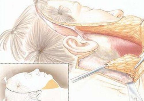 大拉皮手术15天是什么样子?