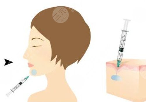 正规医院注射除皱价格是多少？