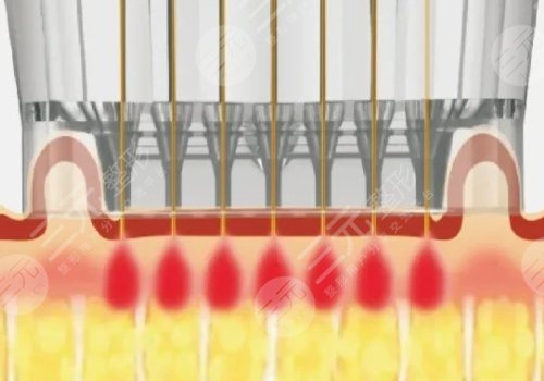 微针美塑和黄金微针的区别盘点