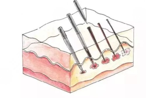 微针美塑和黄金微针的区别盘点