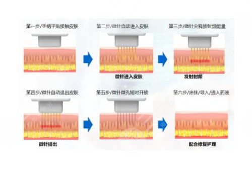 微针美塑和黄金微针的区别盘点