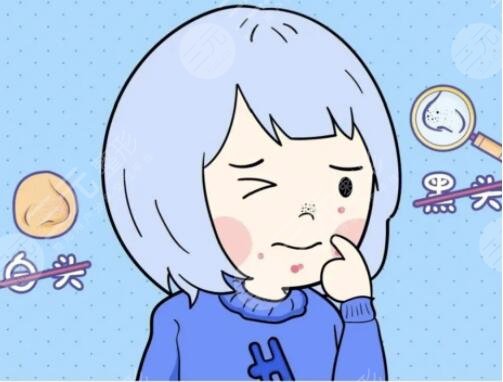 去黑头有效的方法有哪些起效快速？5个好用的方法，一周一次