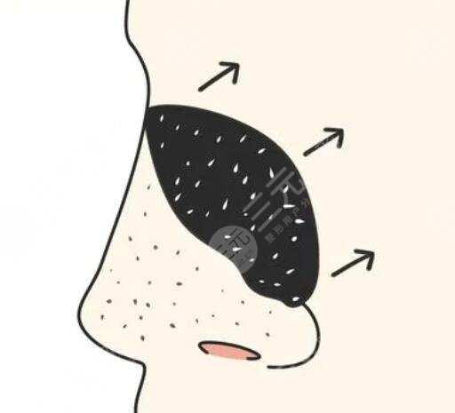 小气泡深层清洁