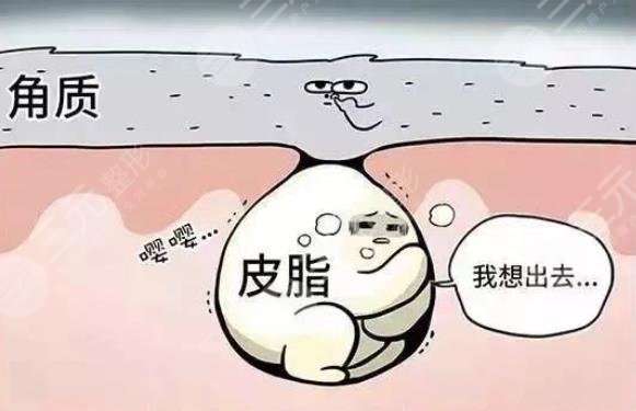 闭合性粉刺怎么彻底去除