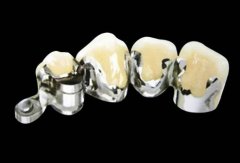 非金属烤瓷牙和全瓷牙的区别在哪？牙齿修复必看，牙冠选择指南！
