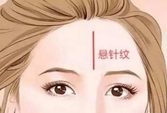怎么去掉悬针纹,可以手术吗?除皱紧肤,一文讲解! 怎么去掉悬针纹,可以手术吗?除皱紧肤,一文讲解!