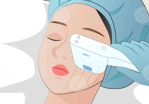 微调整形都有什么项目?