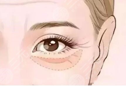 重庆西南医院毕胜医生去眼袋手术案例