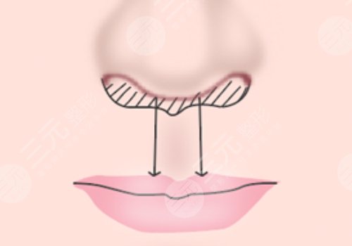 缩短人中的几种方法