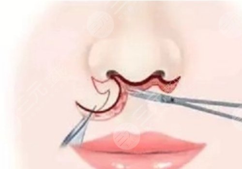 缩短人中的几种方法